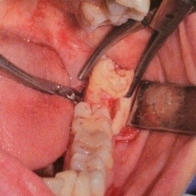 Chirurgia dentale ed estrazioni