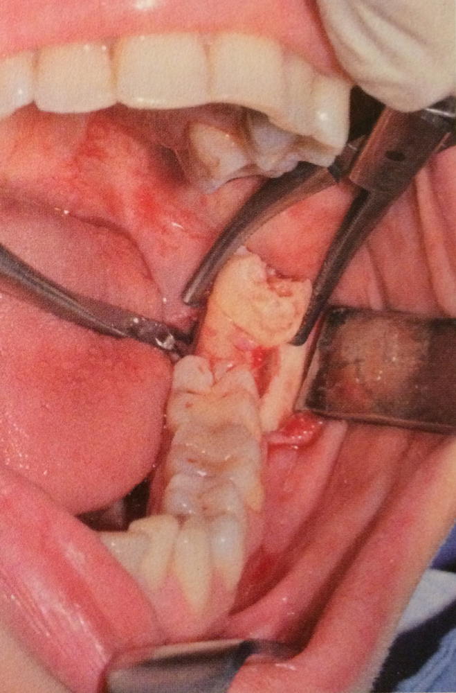 chirurgia-estrazione-denti